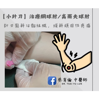 網球肘 - 醫案三