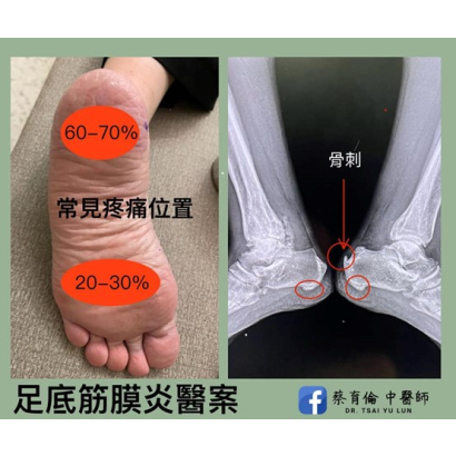 足底筋膜炎 - 醫案二