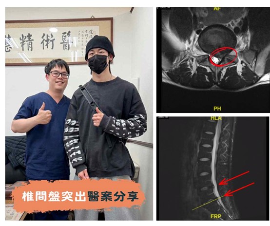 椎間盤突出臨床醫案照片