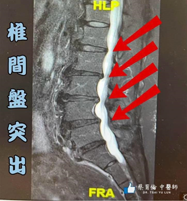 腰椎滑脫椎間盤突出針刀治療案例