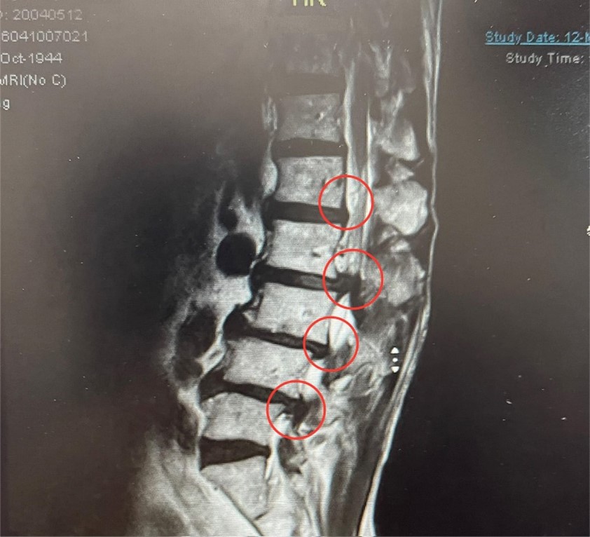 椎間盤突出治療照片2