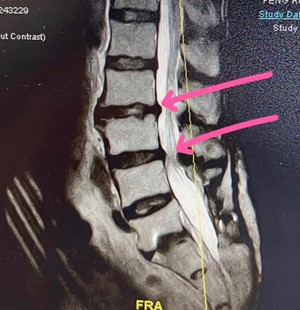 椎間盤突出手術後治療照片2