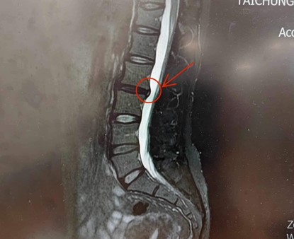 腰椎滑脫治療照片2