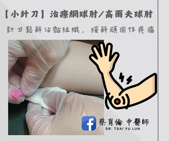 網球肘治療紀錄